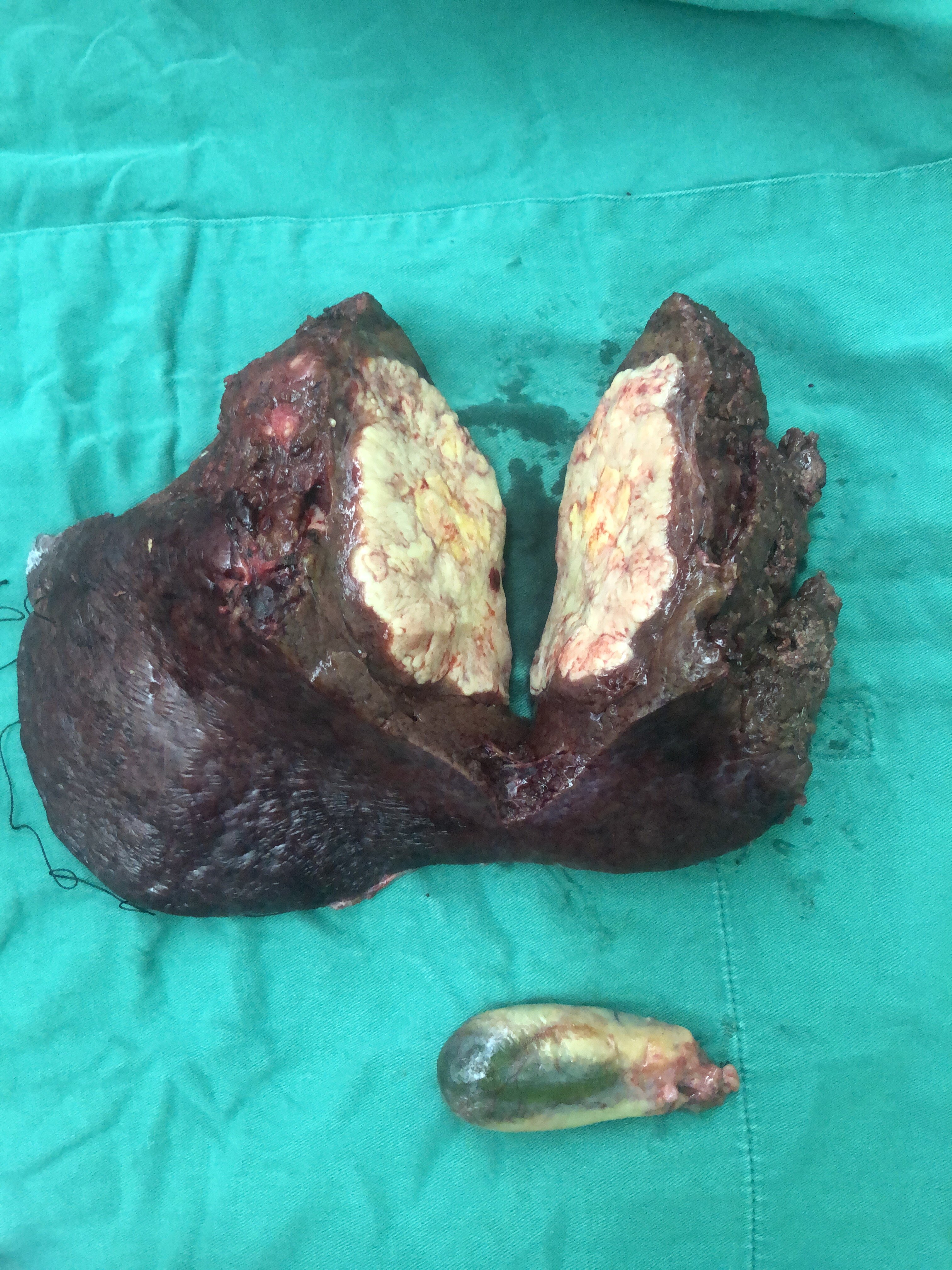 巨大肝癌行右半肝切除手术1例