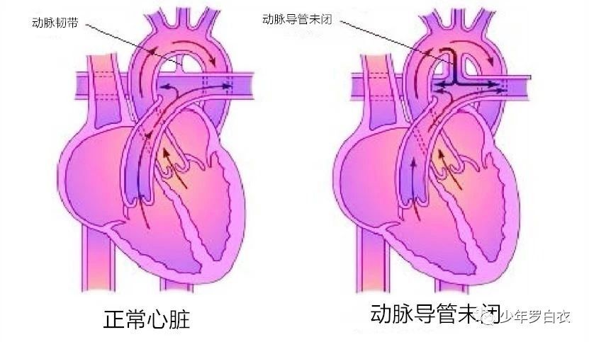 先天性心脏病动脉导管未闭的前世今生