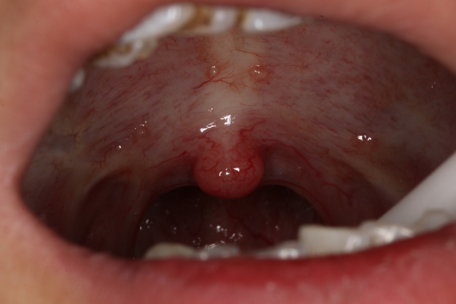 口腔黏膜下纤维化知多少_口腔粘膜病 - 好大夫在线