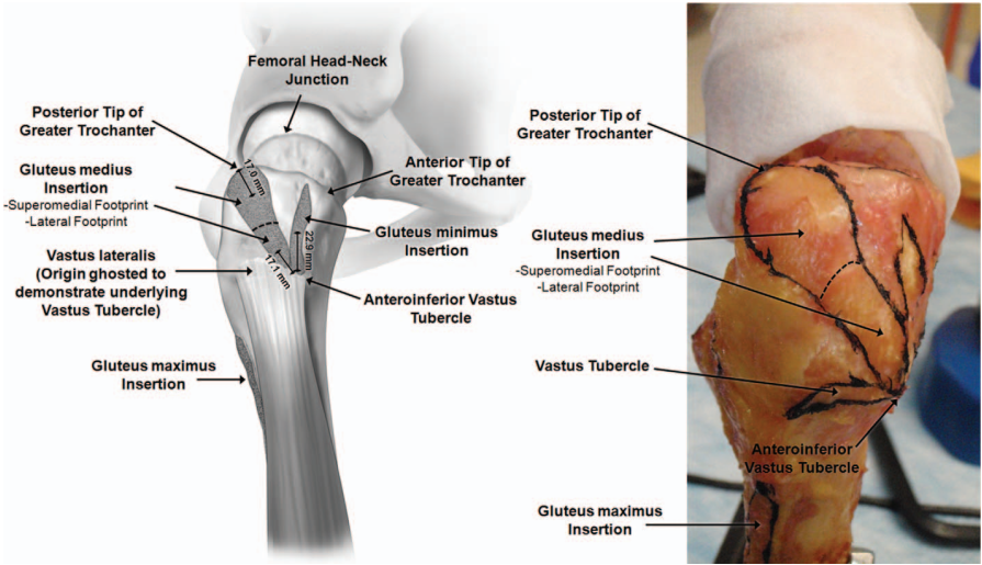 股骨近端与手术相关的骨和软组织解剖