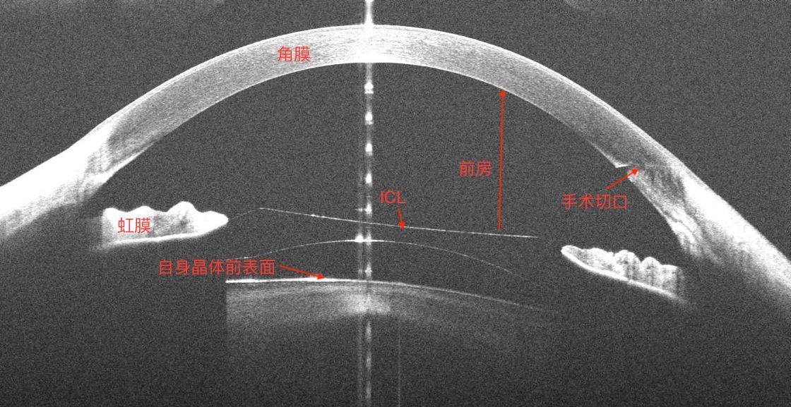 重视icl植入术后6小时内眼压监测