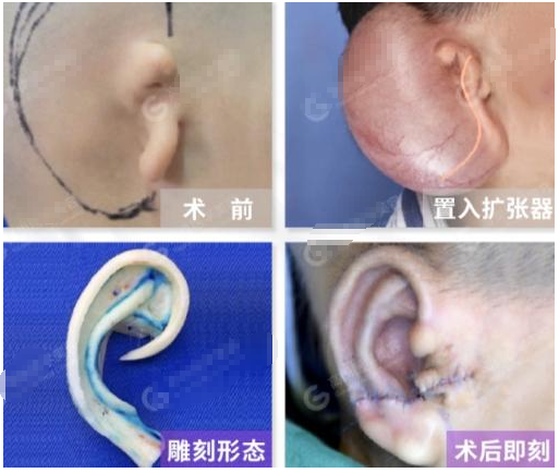 耳朵畸形分哪几种如何辨别