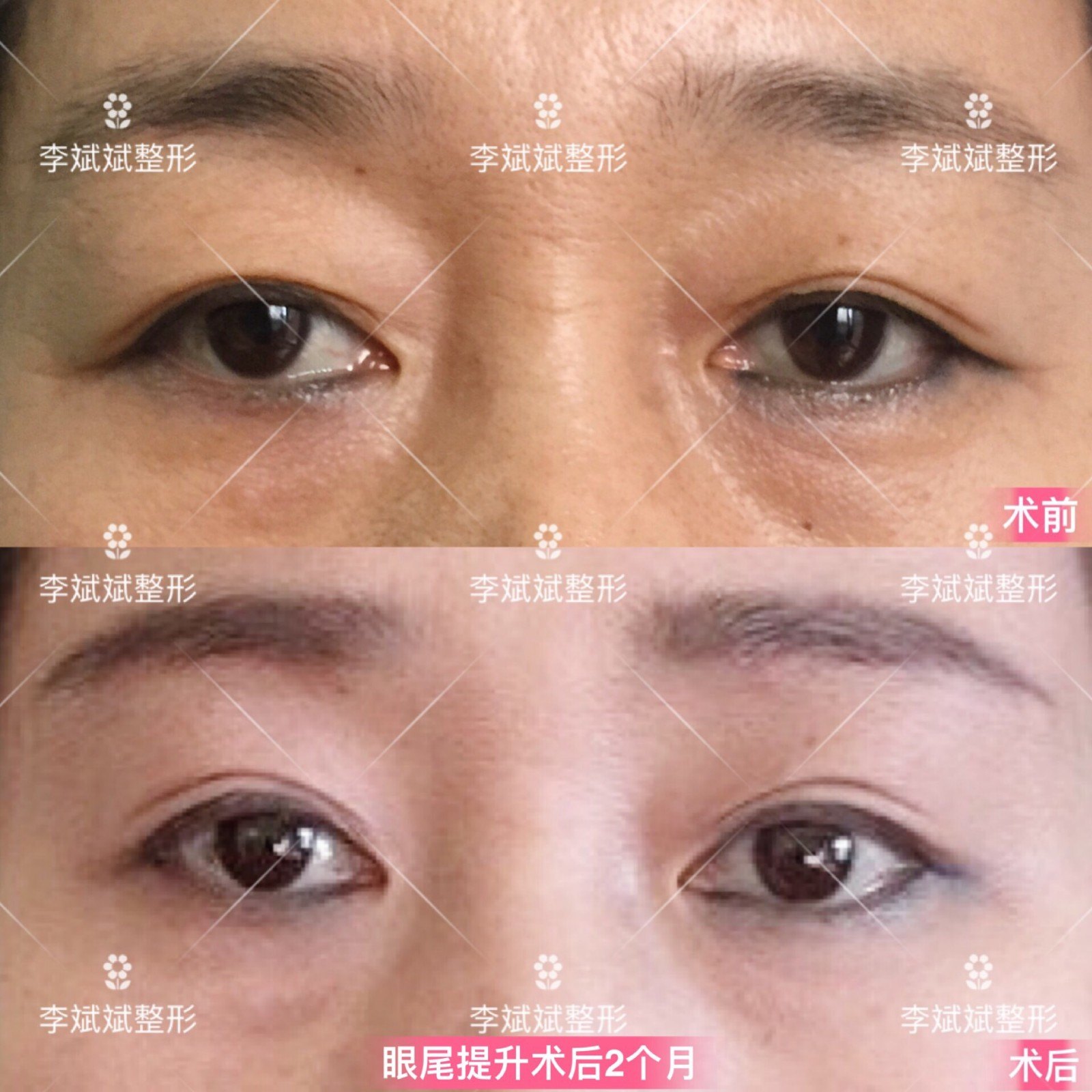 红色虚线框内皮肤松弛下垂,则需要通过眼尾提升手术切除提升