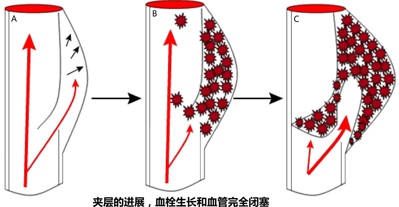 颈脑动脉夹层