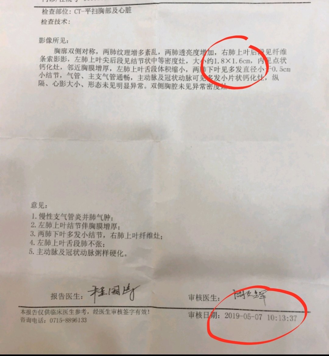 刘懿博士说肺癌(一一七五)肺结节长成晚期肺癌前有很多机会可挽救