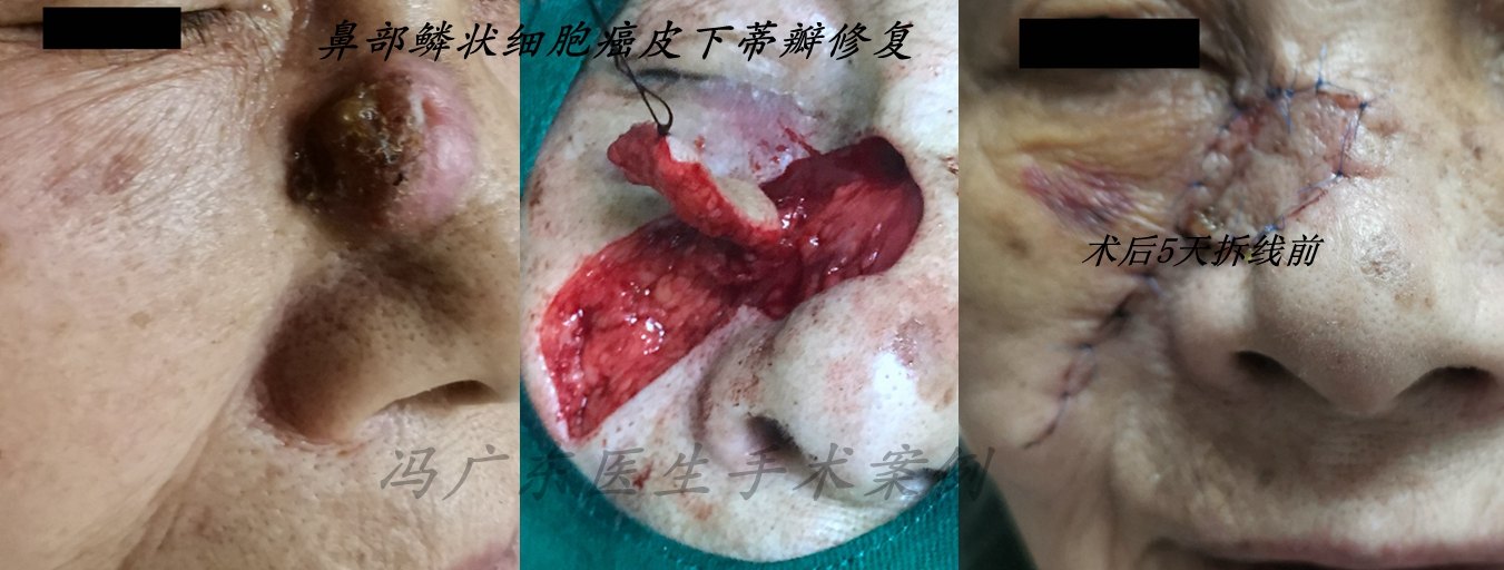 皮肤外科门诊之皮肤鳞状细胞癌