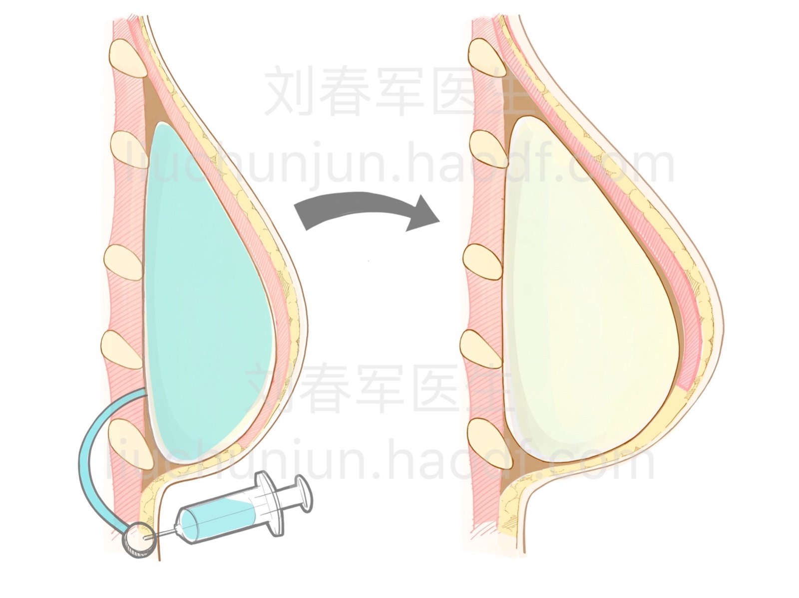 手术过程相对短. 2.  假体 乳房再造的缺点有哪些?