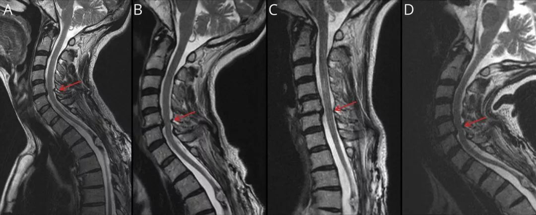 一些栓系患者可能会出现缓慢进展的脊髓病