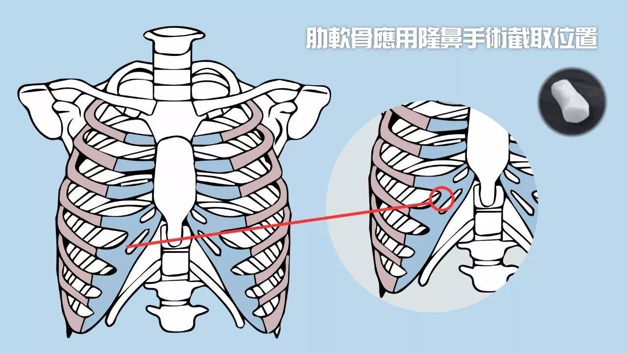 隆鼻科普丨取肋软骨真的很痛吗?