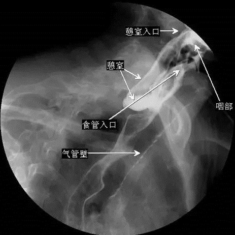 咽食管憩室