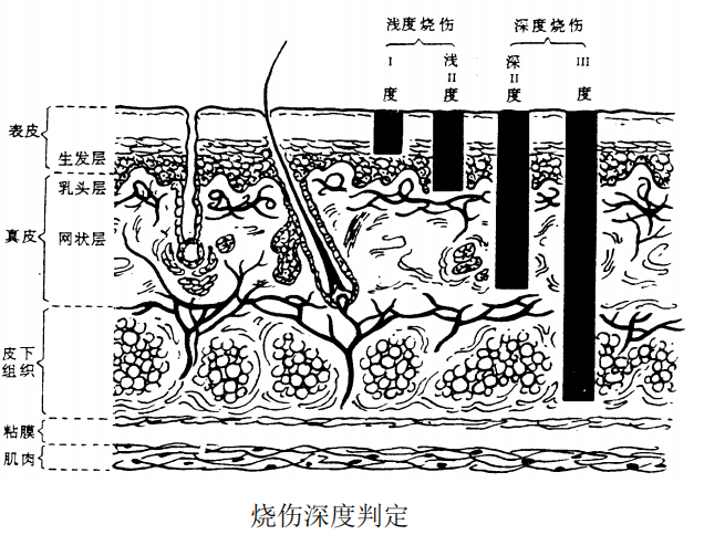 烧伤深度的判定