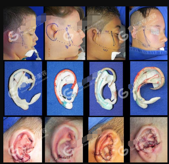 自体肋软骨造耳可以永久维持,部分患者可能会有肋软骨缓慢吸收,形态
