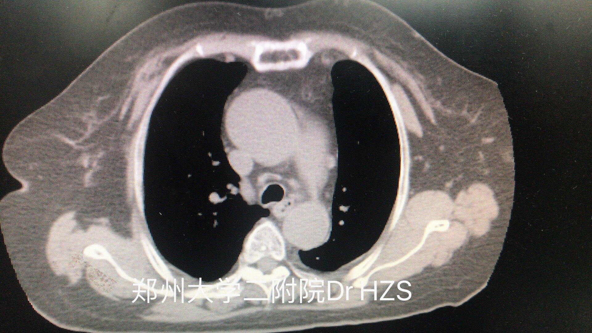 胸腺瘤的最佳术式胸腺瘤切除后是否胸腺及脂肪清扫