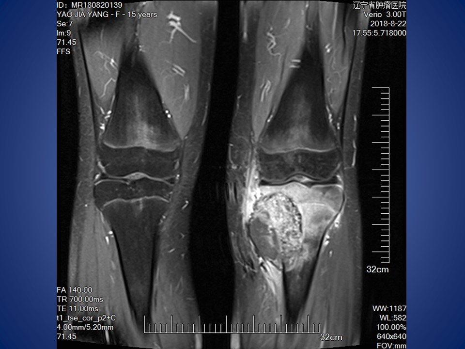 胫骨骨肉瘤肿瘤型膝关节假体置换术
