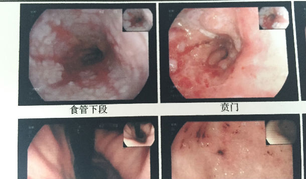 典型反流性食管炎内镜下表现