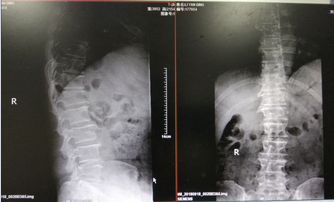腰椎间盘突出症成功保守治疗1例