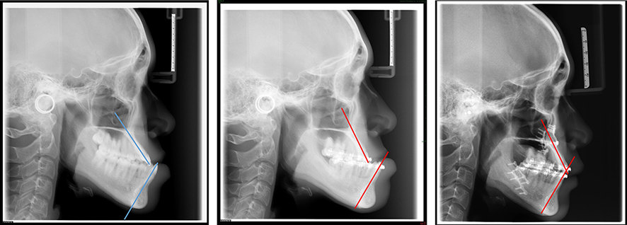 骨性iii类牙颌面畸形地包天的正畸正颌联合治疗