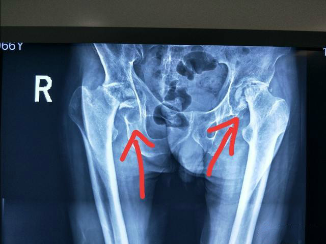 股骨头坏死 的表现,而髋关节不疼,就要慎做手术了.