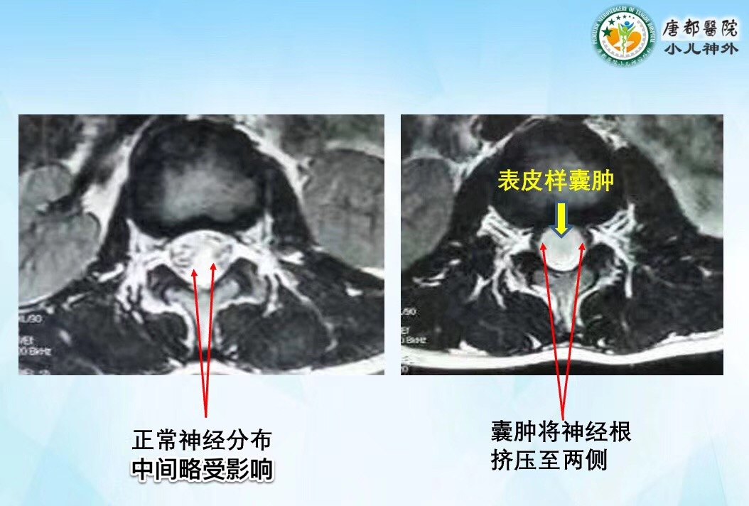 腰2椎管内表皮样囊肿