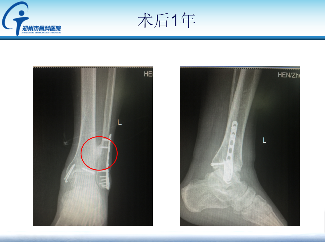 踝关节骨折术后下胫腓骨性连接原因分析