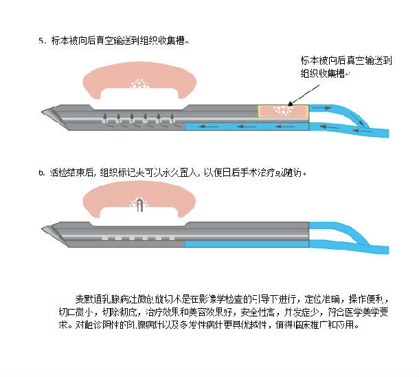 乳腺包块麦默通微创切除手术介绍