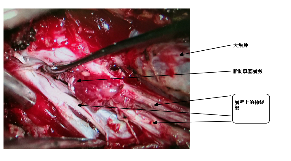 实图简介骶神经根囊肿骶管囊肿的手术治疗2