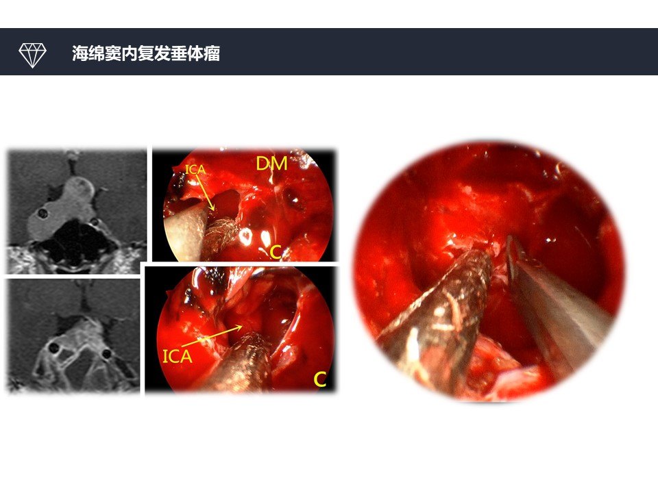 神经内镜切除垂体瘤-海绵窦不再是禁区