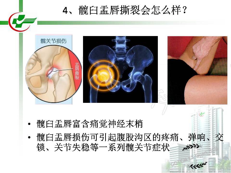 "左臀部盂唇撕裂"是怎样一种体验?