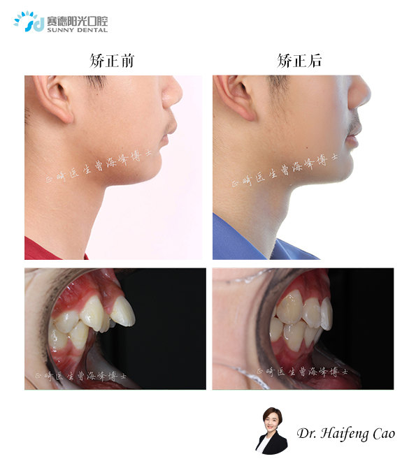 早期矫正下颌后缩纠正小鸟嘴