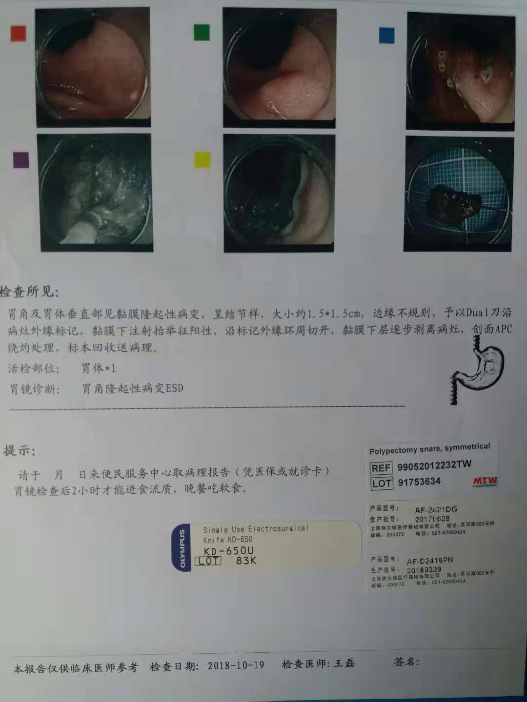 胃癌癌前病变的esd切除