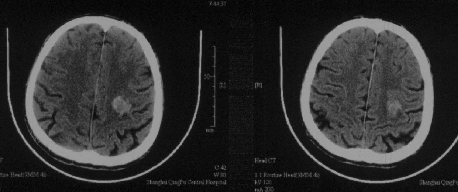 8cm,给予对症改善循环,控制血压治疗,查颅脑mri提示左侧半卵圆中心