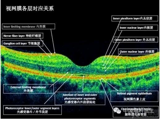 视网膜中央静脉阻塞