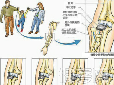 在床上翻滚时,身体将上肢压在身下,迫使肘关节过伸等外力造成