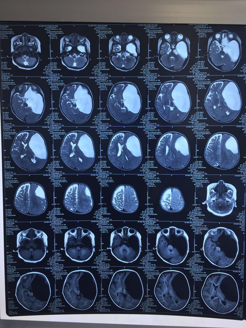 典型案例:蛛网膜囊肿切除术后复查