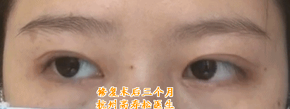 眼修复案例(资料:术前睁眼,闭眼医学摄影,术后三个月睁眼,闭眼,动态