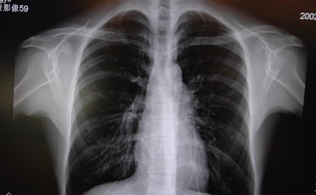 肺纹理增粗可能是肺癌吗体检报告中纹理增粗代表什么要治疗吗