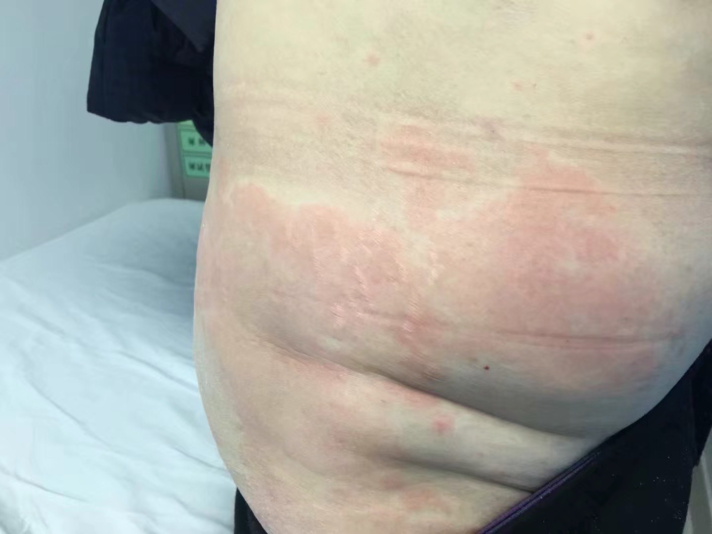 好大夫在线 王彩红 > 了解注射胰岛素治疗的不良反应 局部过敏仅为
