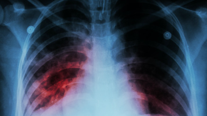 肺内出现钙化灶,是肺癌吗,需要治疗吗?
