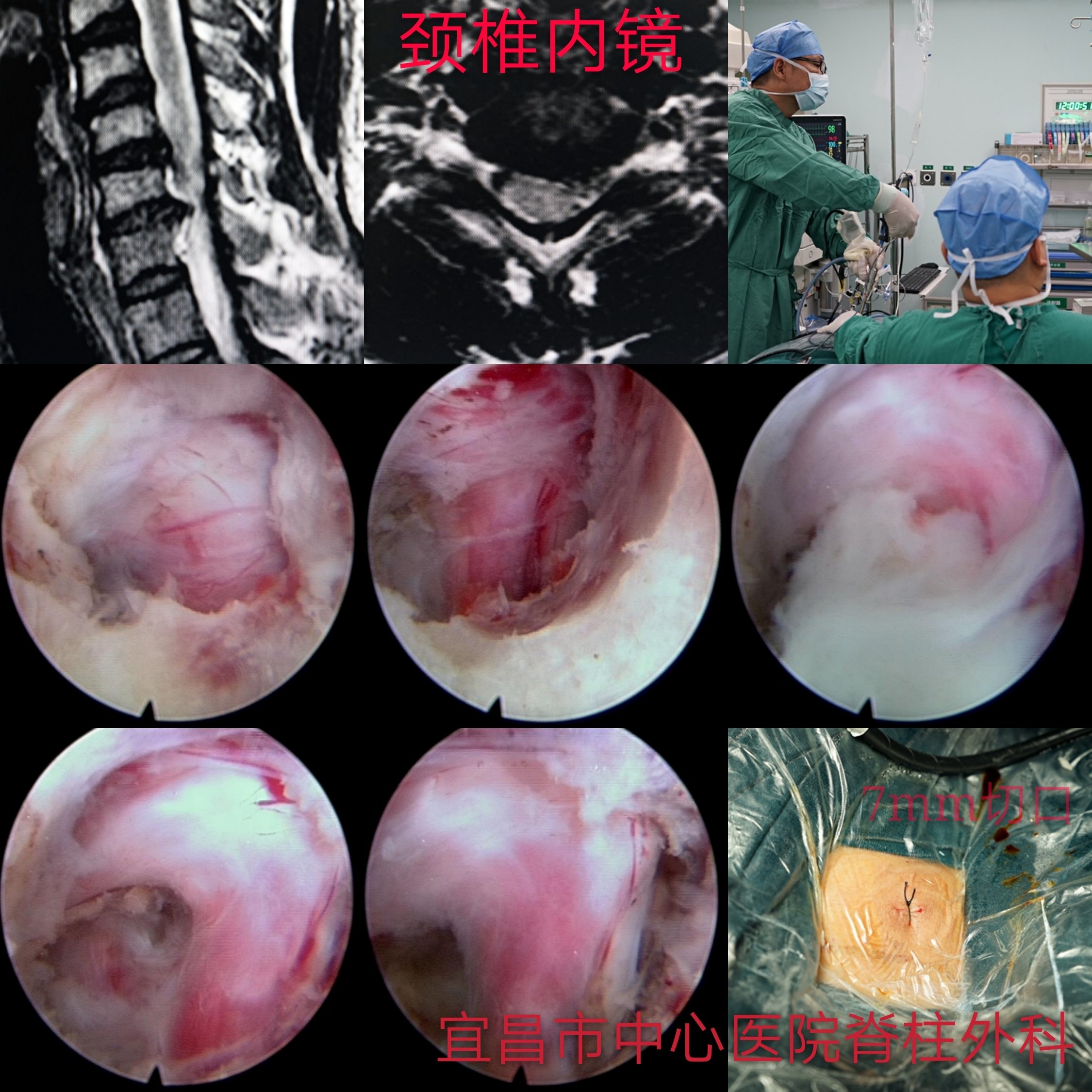颈椎acdf手术经皮内镜手术