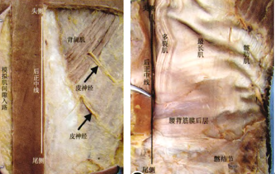 慢性腰痛与椎旁肌