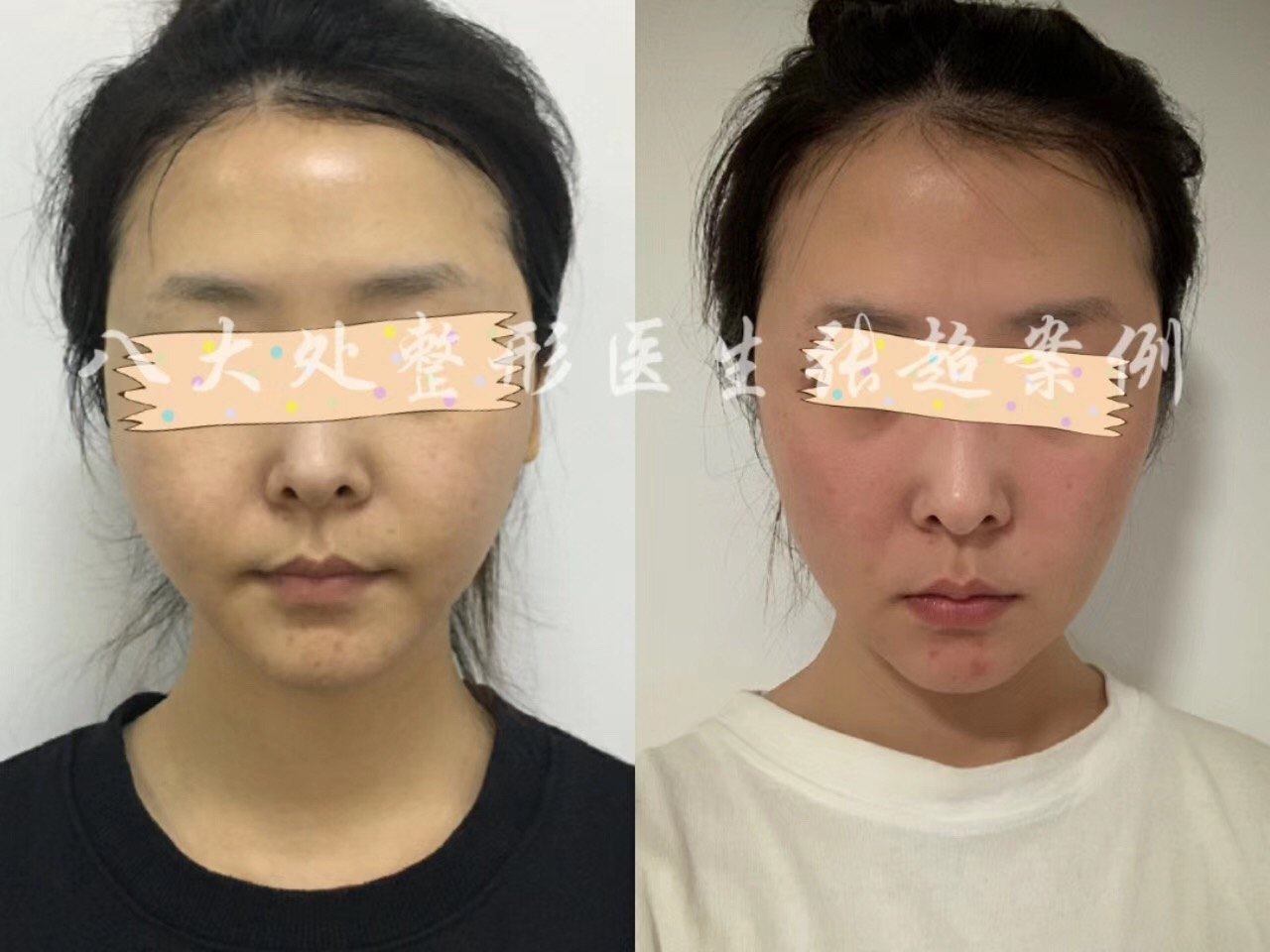 【面部吸脂小科普】面部吸脂的同时需要取颊脂垫吗?