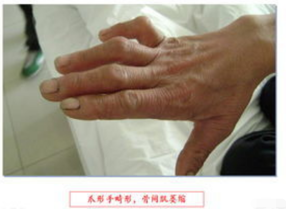 手麻,手指活动不灵活是怎么回事?