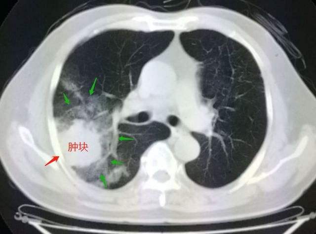 【防癌抗癌】你知道肺癌是怎么诊断的吗