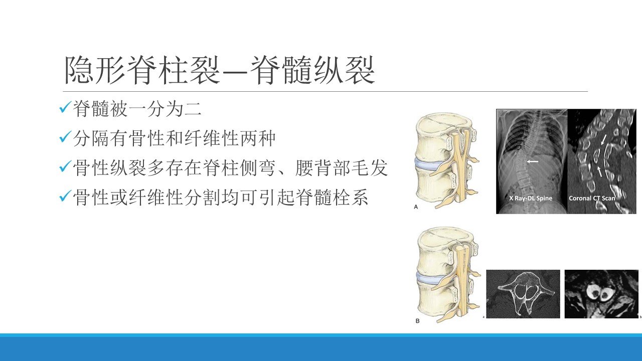脊柱裂的常见类型及治疗原则