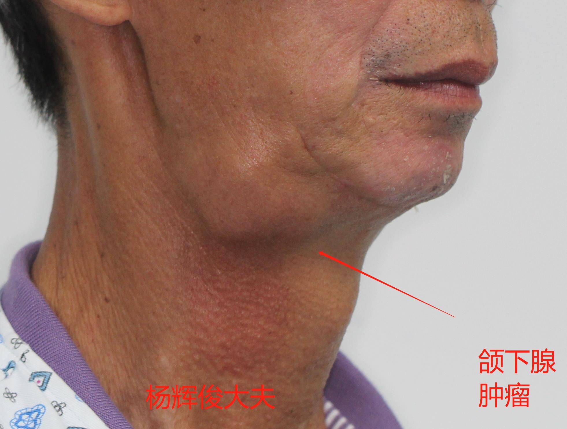 甲状舌管瘘 皮样囊肿,颏下淋巴结炎 颌下淋巴结炎,颌下区囊肿,颌下区