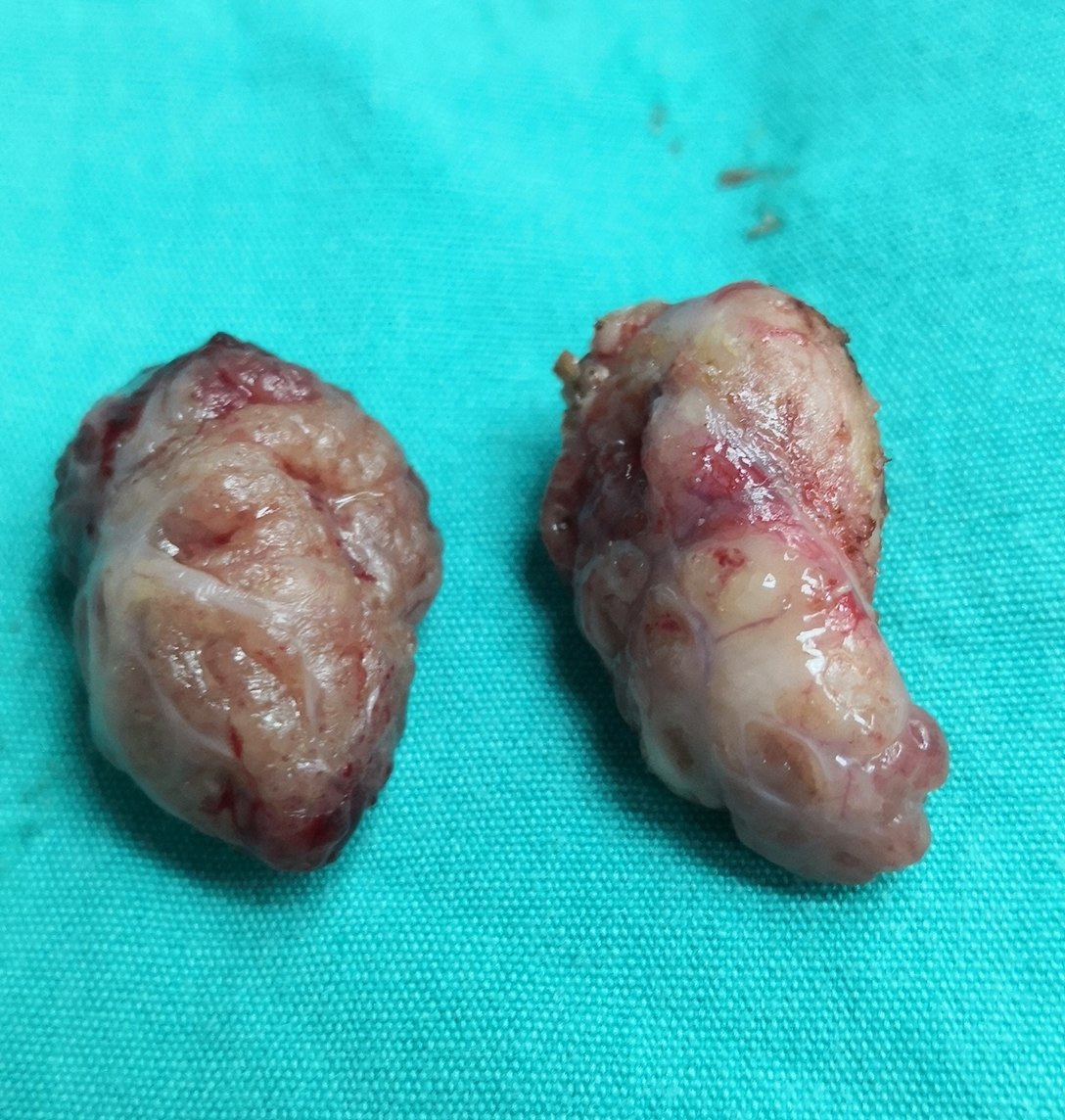 小儿扁桃体腺样体手术该切或是不切什么时候切