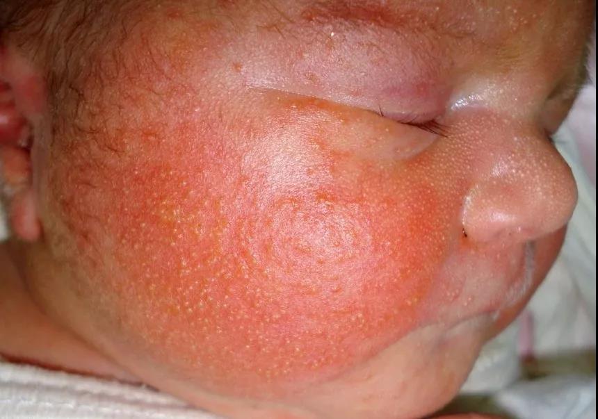 图5. 新生儿毒性红斑(面部)和粟丘疹(鼻部)