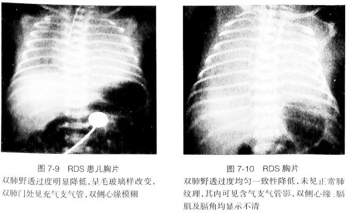 新生儿呼吸窘迫综合征