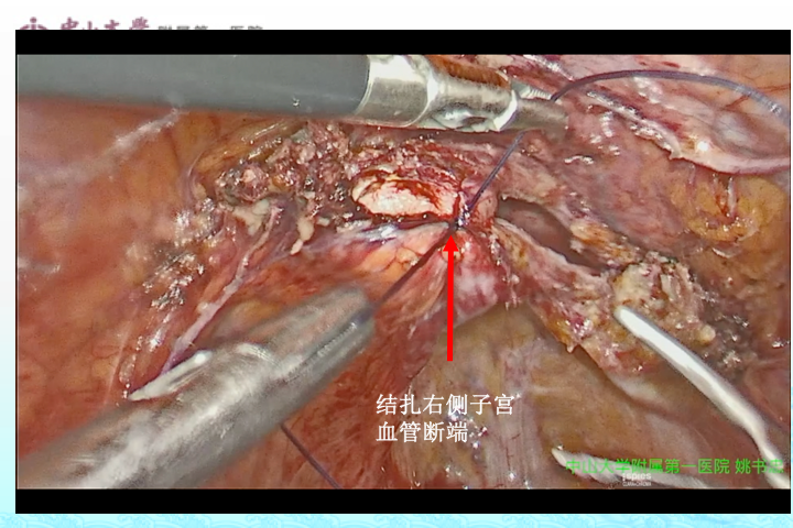 20.  缝合结扎右侧子宫血管