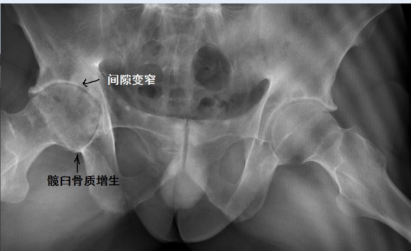 强直性脊柱炎,髋关节受累会如何?
